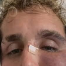 Shocking Images Of Jake Paul's Swollen Face Leak Online After Anthony  Joshua Broke His Jaw [PHOTOS] Full story via 🔗 in comments. 👇