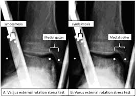 Image result for Ankle External Rotation Test