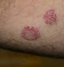 Some people with psoriasis find that they deal with frequent skin infections on top of psoriasis symptoms. Diagnostic In Imagini 6 Revista RomanÄ De Medicina Familiei