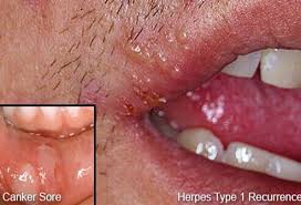 Cold Sore And Canker Sore Picture Image On Medicinenet Com