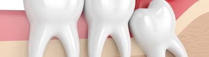 We did not find results for: Is Wisdom Tooth Extraction Painful Wisdom Teeth Removal Canberra