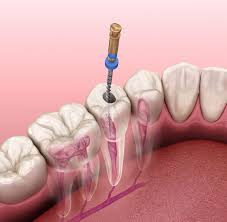Send thanks to the doctor dr. Root Canal Therapy North Point Dental Associates