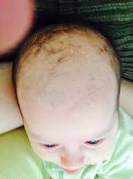 Small amounts of hair fall post this period is also considered normal. Baby Hair Loss And Dandruff Pic Babycenter