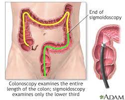 If you are of african american descent. Colon Cancer Information Mount Sinai New York