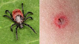 Seek medical attention if you observe any of these symptoms and have had a tick bite, live in an area known for lyme disease, or have recently traveled to an area where lyme disease occurs. 7 Tick Bites That Can Make You Sick Everyday Health