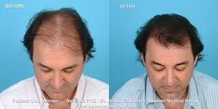 Got HAIR? Hair Transplant, Hair Loss & Hair Growth