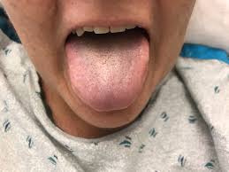 Image result for black hairy tongue symptoms