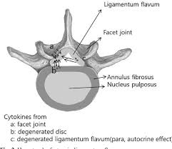 Ligamentum flavum is a highly specialized spinal ligament. Pdf Mechanism Of Ligamentum Flavum Hypertrophy Semantic Scholar