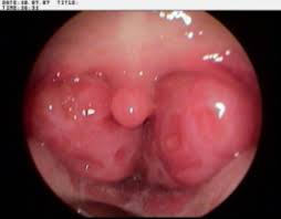 Image result for tonsilla palatina