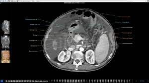 During a ct scan, the patient lies on a table that moves through a. Anatomie Der Bauch Und Beckenhohle Und Bauchfell Auf Einer Ct