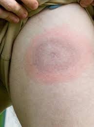 Lyme Disease Treatment Nyc By Marc Bystock L Ac