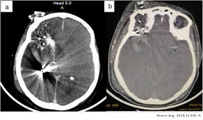 El derrame cerebral puede ser. Disociacion Clinico Imagenologica En Determinacion De Muerte Encefalica Neurologia Argentina