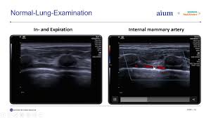 Lung Ultrasound In Patients With Covid 19 Disease Youtube