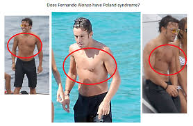 Sometimes called poland sequence, it was first described by poland (1841). Jelena2112 On Twitter Fernando Alonso Has Poland Syndrome If You Dont Know About This Condition You Can Read Here Http T Co Uuctjf78 Http T Co Eog1yv7t