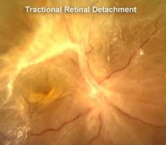 The best way to preserve vision is through annual, detailed eye exams with a doctor who specializes in your unique eye condition. Diabetic Tractional Retinal Detachment