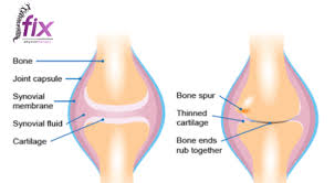 Lokasi sakit lutut berbeza dan bergantung kepada mana satu struktur yang terlibat. Senaman Berkesan Untuk Lutut Osteoarthritis Oa