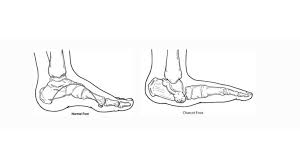 Charcot Foot Causes Symptoms And Treatment