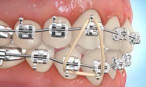 Invisible braces provided by orthodontists, are comparable in price to traditional braces. How To Put Rubber Bands On Braces Premier Orthodontics