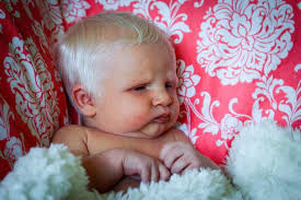 The white hair is caused by poliosis, a condition that creates a lack of pigment in the hair and mommy is beautiful and that baby is absolutely gorgeous!! Newborn Baby With Shock Of White Hair Sends Internet Into Meltdown With Snowy Locks World News Mirror Online