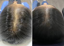 Alopecia femenina