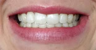 To prevent or fix a lisp due to invisalign, keep talking! Will My Child Outgrow A Lisp Speech Pathways