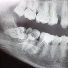 Preoperative Position Of Inferior Wisdom Tooth Download Scientific Diagram