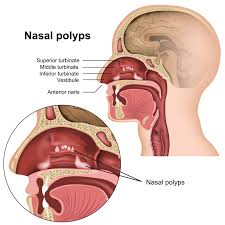 Nasal polyps soft growths that develop on the lining of the nasal or sinus passages. Nasal Polyps Overview Diagnosis Treatment Auricle Ent Clinic