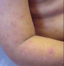 Image result for Papular urticaria