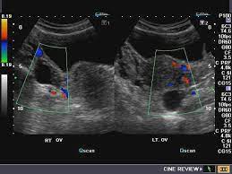 We did not find results for: A Gallery Of High Resolution Ultrasound Color Doppler 3d Images Ovaries