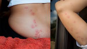 Image result for bedbugs bites
