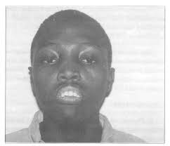 ALVEOLAR OSTEOTOMY FOR CORRECTION OF ANTERIOR OPEN BITE