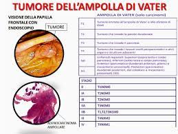 I tumori della papilla di vater. Carcinoma Dell Ampolla Di Vater Diagnosi E Cura