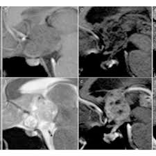 Can Meditation Increase Your Height Naturally After 18?