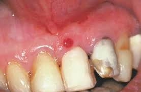 Image result for granuloma gum disease