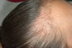 Ceci peut cependant prendre de quelques semaines à plusieurs années. Dermato Info L Alopecie