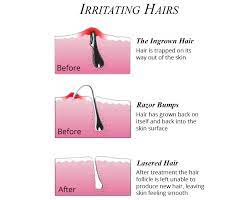 Ingrown hair is often faced by people who have curly or coarse hair. Can Your Dermatologist Be The Answer To Your Ingrown Hair