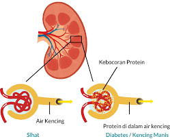 Golongan yang berisiko tinggi untuk dapat gdm mempunyai sejarah kencing manis keluarga pernah melahirkan bayi yang beratnya lebih daripada 9 paun atau mempunyai kecacatan kelahiran ya, terdapat beberapa kesan buruk dan juga komplikasi semasa dan selepas kelahiran. Penyebab Utama Penyakit Diabetes The National Kidney Foundation Nkf Singapore