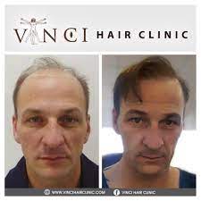 Pin On Hair Transplants Before After Pictures