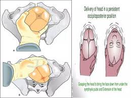 Image result for Manual Rotation in Occipitoposterior Presentation