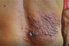 Conocer el herpes zóster - Plan de Vacunaciones de Andalucía (Andavac)
