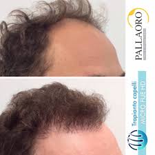 L'età degli uomini interessati a questo tipo d'intervento oscilla tra i 20 e i 60. Hsd Trapianto Capelli Diradamento Frontale Risolverlo Con Il Trapianto Micro Fue Https Www Chirurgiatricologica It Diradamento Frontale Uomo Html Facebook