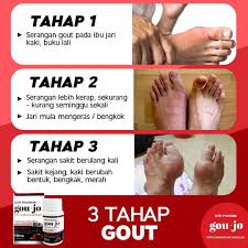 Ibu saya telah mengalami sakit lutut dan susah hendak berjalan.nampak berkerut mukanya menahan sakit bila berjalan. Rawat Sendi Lutut Dan Gout Photos Facebook