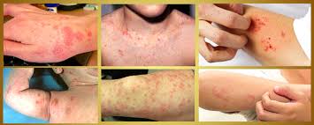 Image result for scabies on humans
