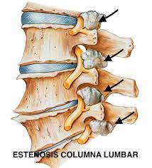 ¿qué es un estenosis aórtica? Recalibrado Endoscopico Estenosis Canal Vertebral Lumbar