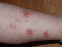 Image result for Eczema nummulare