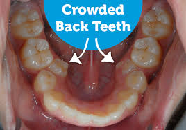A misaligned bite can be caused by a wide range of problems, known as malocclusions. Crowded Back Teeth Braces In South Brunswick Nj