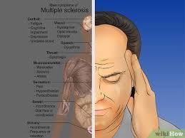 اعراض التصلب اللويحي في العين بالثلاثة ويزاحم الهلال