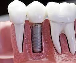Knitting Tutorial Joining Stitches In The Round Stitch And Unwind Teeth Implants Implant Dentist Dental Surgery