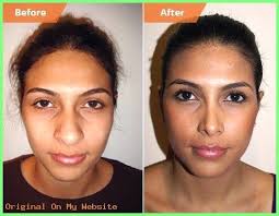 Bulbous Hayek Image Result Rhinoplasty Rhinoplastybulbousnos Salma Tip Rhinoplasty Bulb Nose Surgery Rhinoplasty Before And After Rhinoplasty Nose Jobs