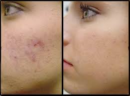 acne ile ilgili görsel sonucu